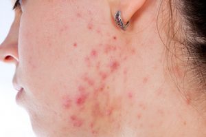 acne on woman's face