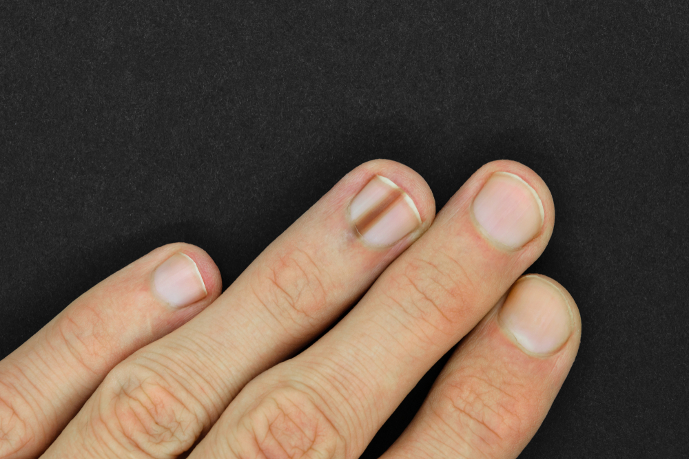 Check Your Nails for Melanoma