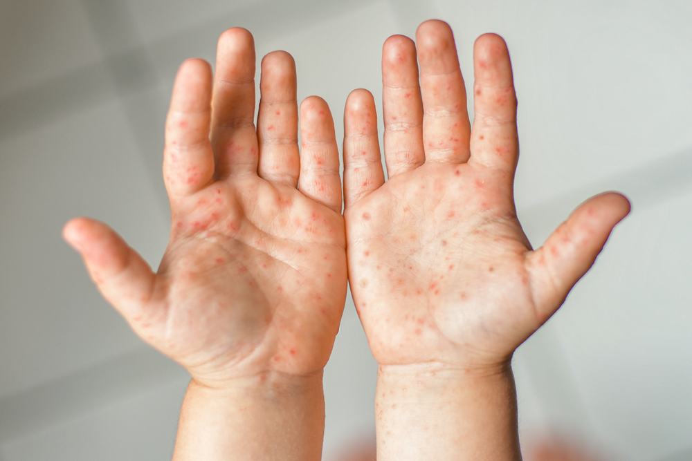 Tips For Preventing Hand-Foot-And-Mouth Disease