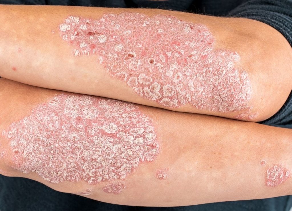 What is Psoriasis & What are the Symptoms and Treatment