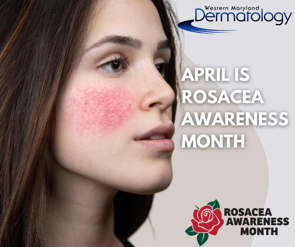 Understanding Rosacea: Shedding Light During Rosacea Awareness Month