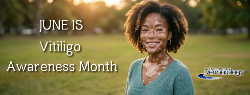 Understanding Vitiligo: Awareness, Causes & Treatment Options